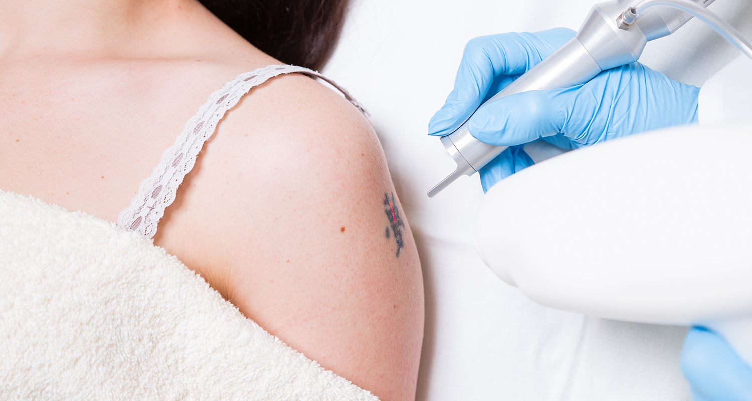 Why You Need An Expert Tattoo Removal in London